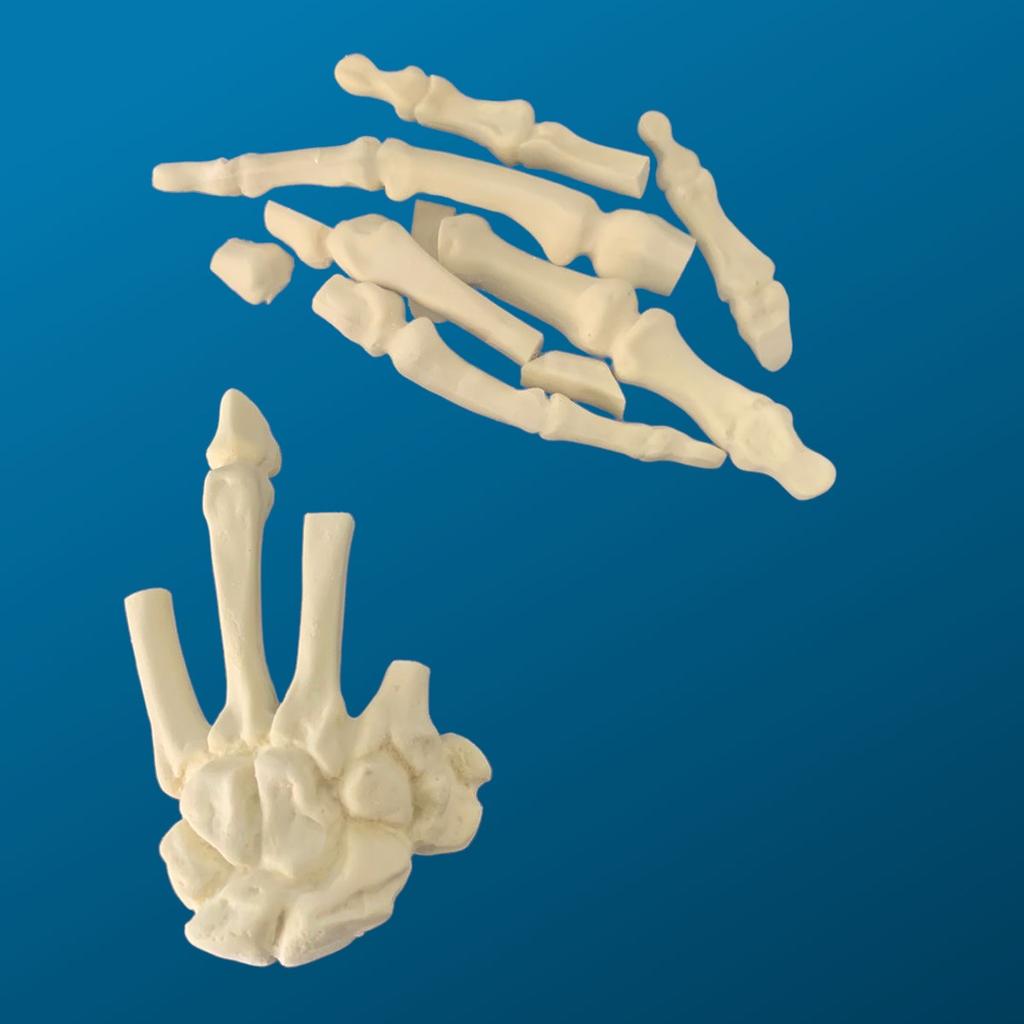Mano con falanges fracturadas