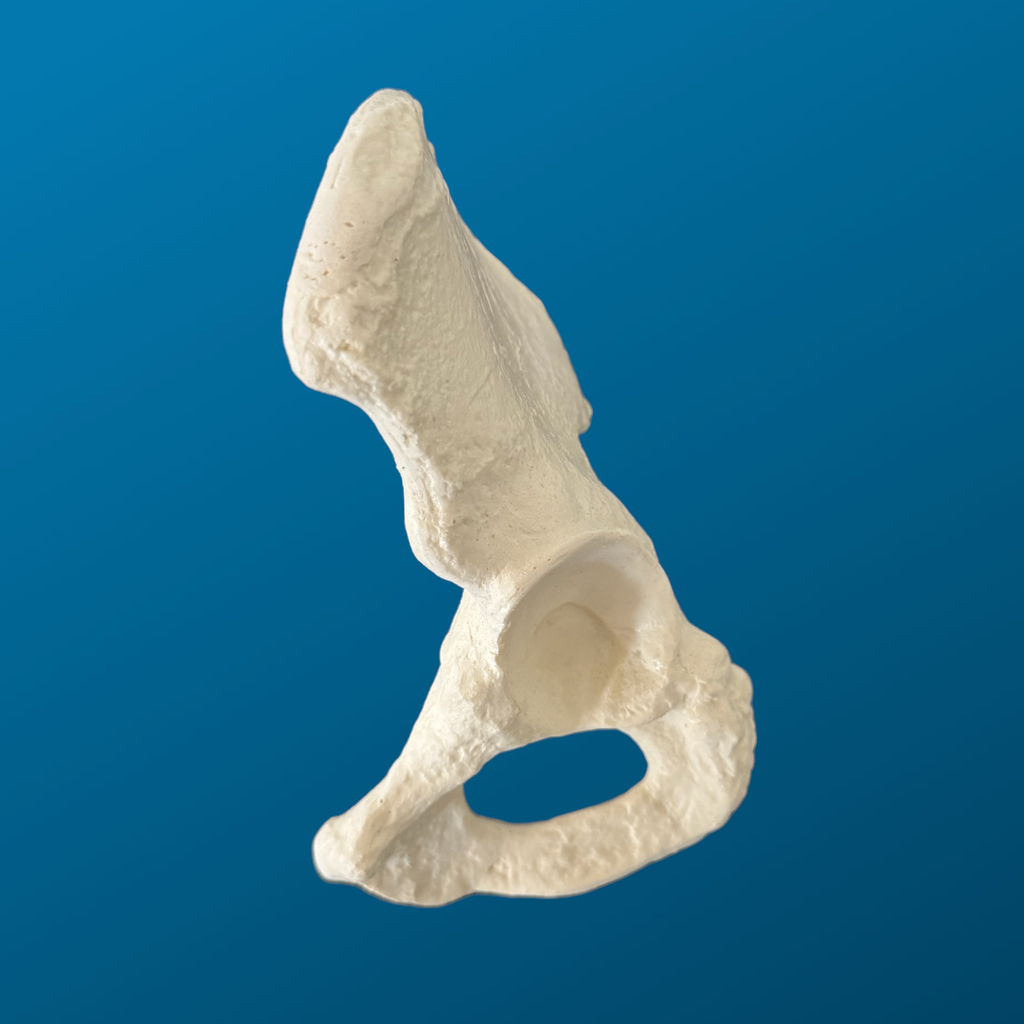Hemipelvis pediatrica displásica, espuma solida, izquierda