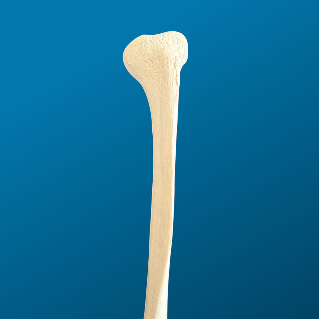 Tibia con deformidad en varo