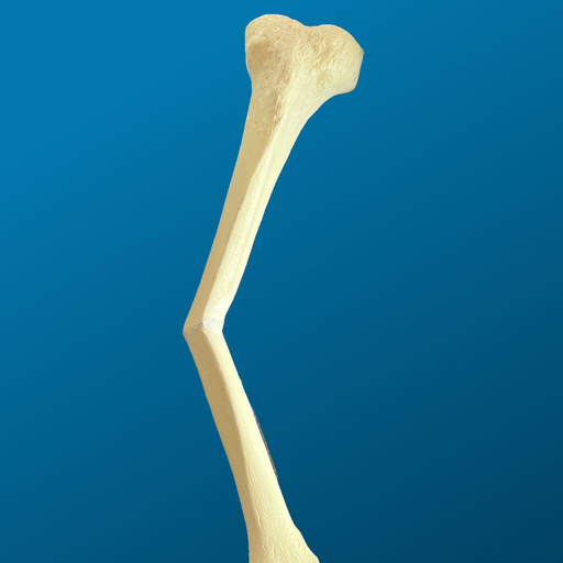 [1223] Tibia con mala consolidación de la diáfisis y defecto en varo de 25 grados
