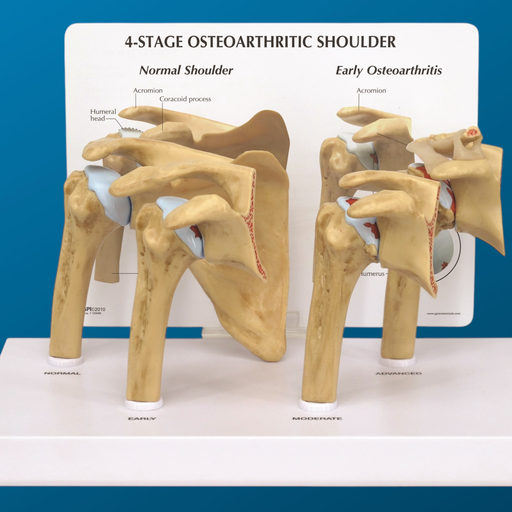 [1612] Osteoartritis de hombro en 4 etapas