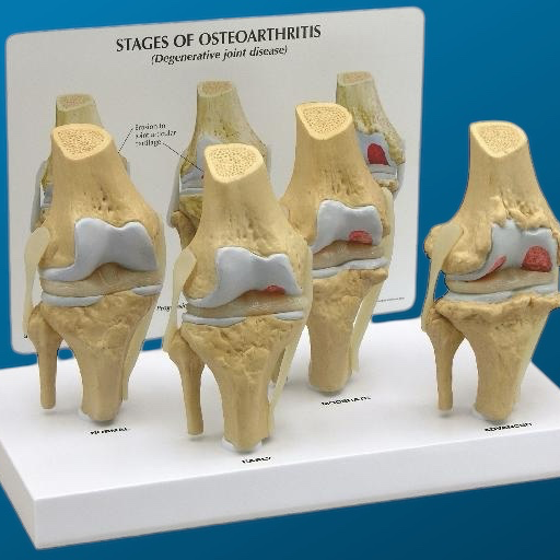 [1613] Osteoartritis de rodilla en 4 etapas
